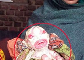ولد نوزاد نفرین‌شده که “بیگانه فضایی” لقب گرفت+ (تصاویر ۱۸+)