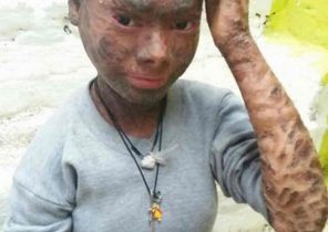 دخترِ مارنمای هندی که هر ۲ ماه یکبار پوست می‌اندازد!+ تصاویر