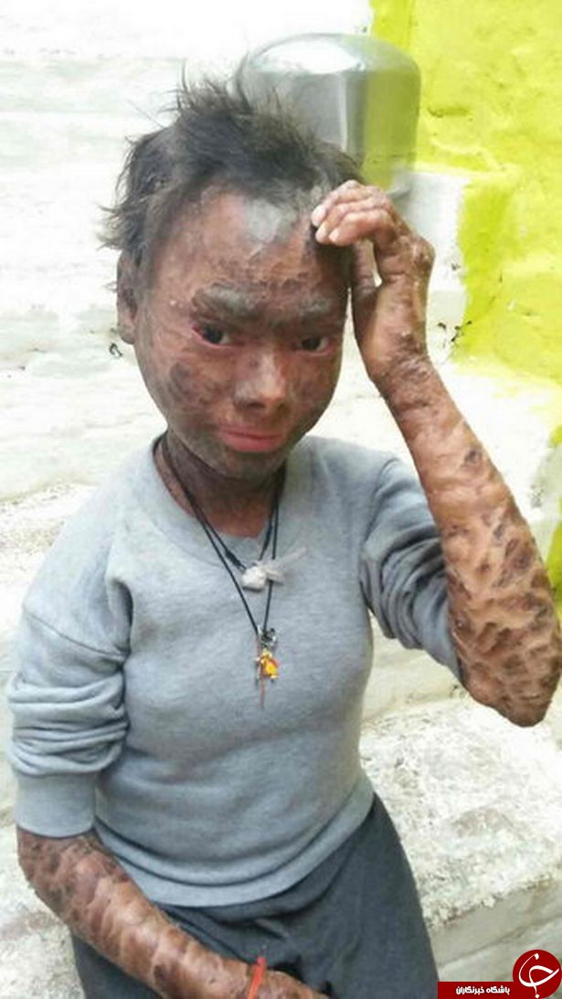 دخترِ مارنمای هندی که هر ۲ ماه یکبار پوست می‌اندازد!+ تصاویر