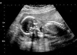 سندروم داون یکی از شایع ترین ناهنجاری جنین/ استفاده بی‌رویه از سونوگرافی توسط متخصصان زنان