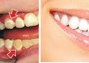 ترفندهایی که دندان‌هایتان را مثل مروارید سفید می‌کند