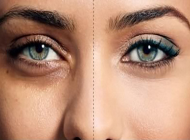 بهترین روش های درمانی برای رفع سیاهی دور چشم