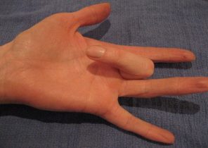 انگشت ماشه ای چه بیماری است و چه طور درمان می شود؟