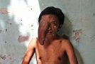 تومور عجیب مرد اندونزیایی که بینایی یک چشمش را از او گرفت