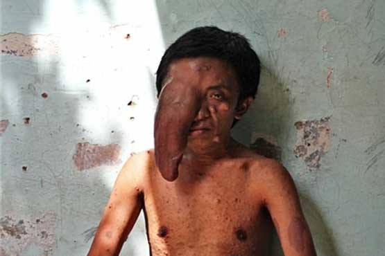 تومور عجیب مرد اندونزیایی که بینایی یک چشمش را از او گرفت