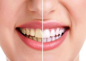موادغذایی که باعث سفیدی دندان شما می شود