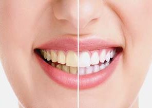 ترفندی جالب برای داشتن دندان های سفید