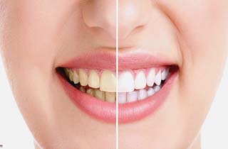 ترفندی جالب برای داشتن دندان های سفید