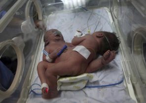 تولد عجیب‌ترین دوقلوهای به هم چسبیده در غزه + تصاویر