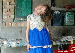 رنج دختری پاکستانی با انحراف ۱۸۰ درجه‌ای گردن+تصاویر
