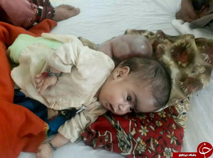  بیماری عجیب کودک پاکستانی! +تصاویر