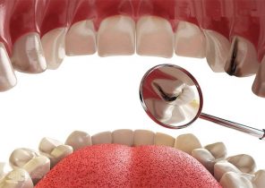 ۶ توصیه اساسی برای جلوگیری از پوسیدگی دندان