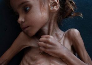 تلفات وسیع تراژدی قحطی و گرسنگی مردم یمن/ وقتی قتل خاشقجی جنایات سعودی ها در یمن را به حاشیه می راند