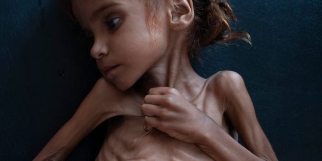 تلفات وسیع تراژدی قحطی و گرسنگی مردم یمن/ وقتی قتل خاشقجی جنایات سعودی ها در یمن را به حاشیه می راند