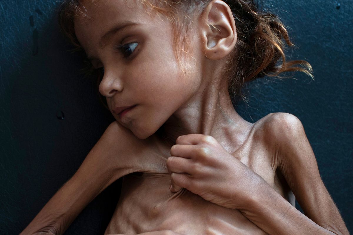 دختری که توجه جهان را به تجاوز بی‌رحمانه عربستان به یمن معطوف کرد، جان باخت
