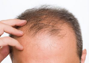 همه آنچه درباره ریزش موی مردان باید بدانید+ راهکارهای درمانی
