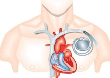 پیوند باتری قلب به روش نیمه‌تهاجمی در کرج
