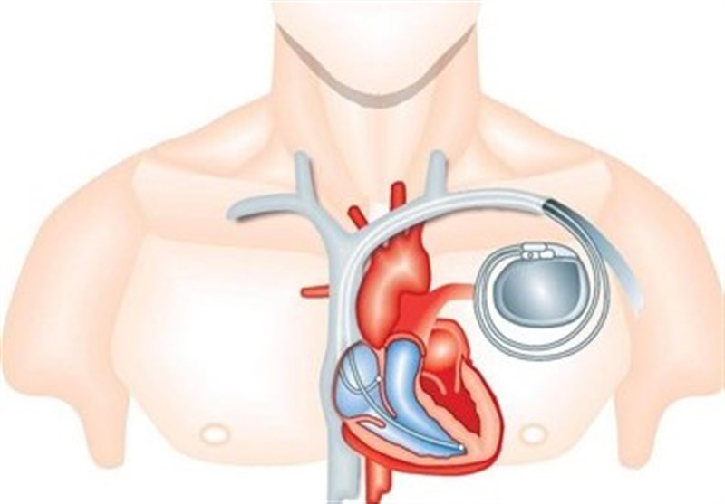 پیوند باتری قلب به روش نیمه‌تهاجمی در کرج