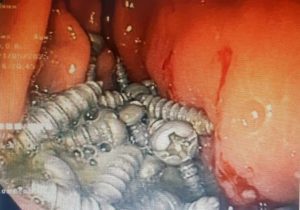 خارج کردن ۴۷ پیچ فلزی از معده یک بیمار در کرج