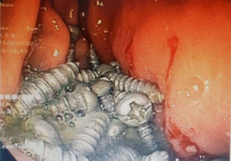 خارج کردن ۴۷ پیچ فلزی از معده یک بیمار در کرج