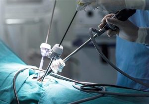 عمل جراحی لاپاراسکوپی موفق در کرج/ خروج کیست مویی ۱۰ سانتی